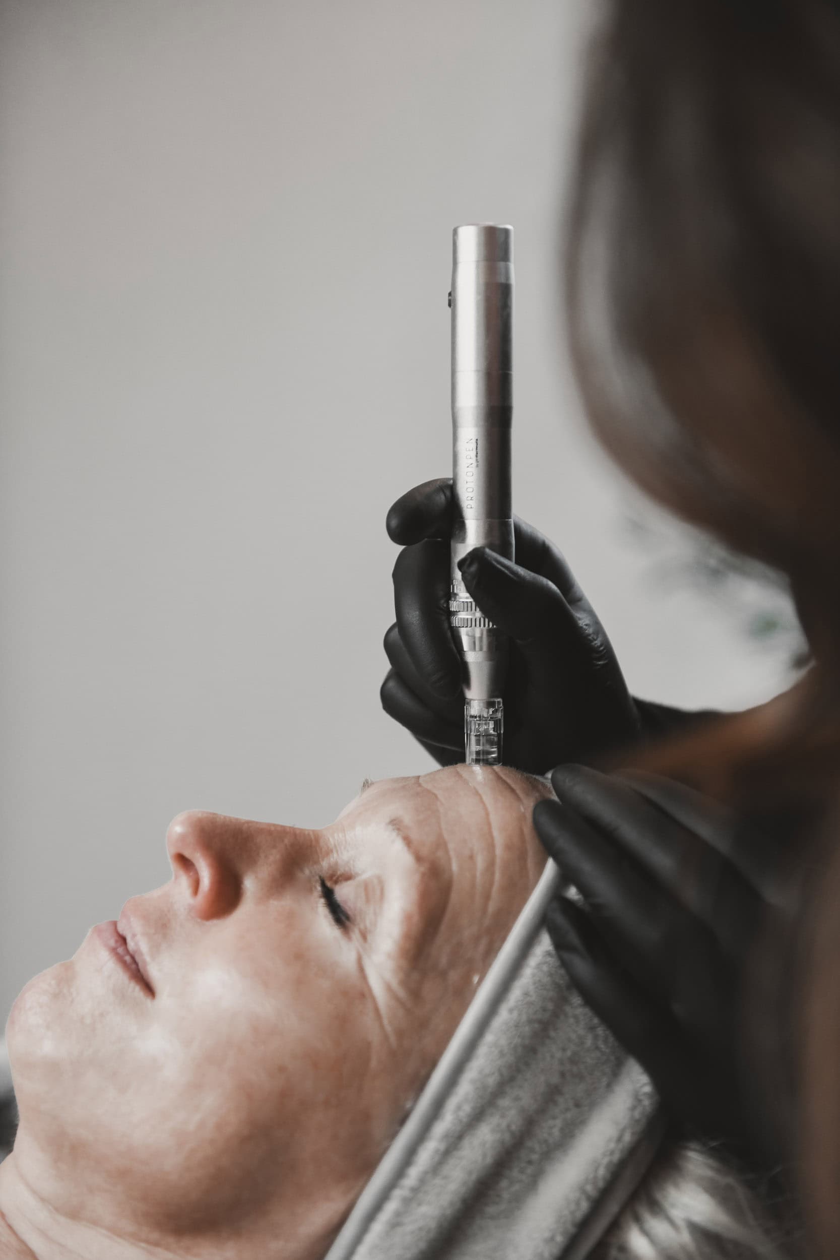MICRONEEDLING