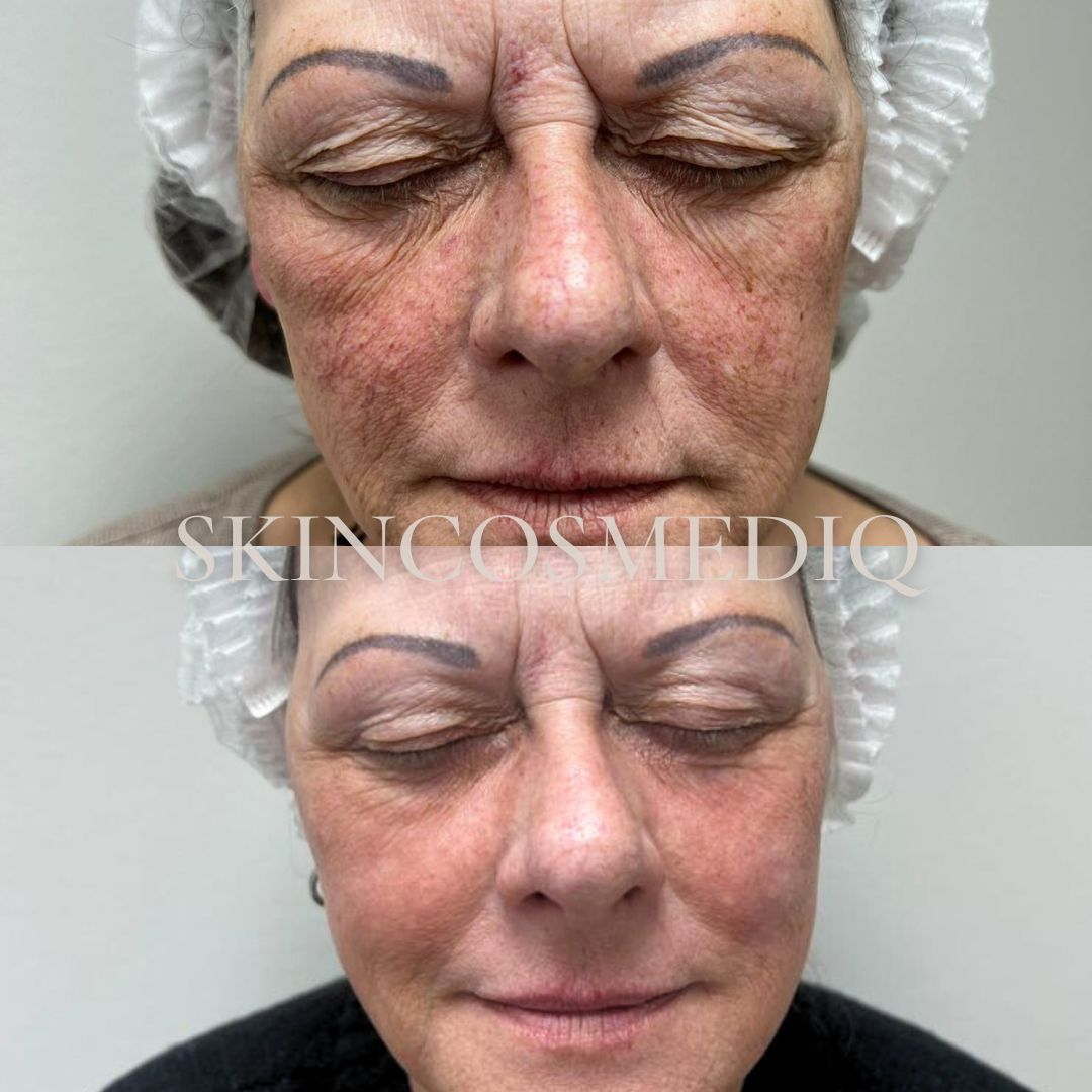 B&A5