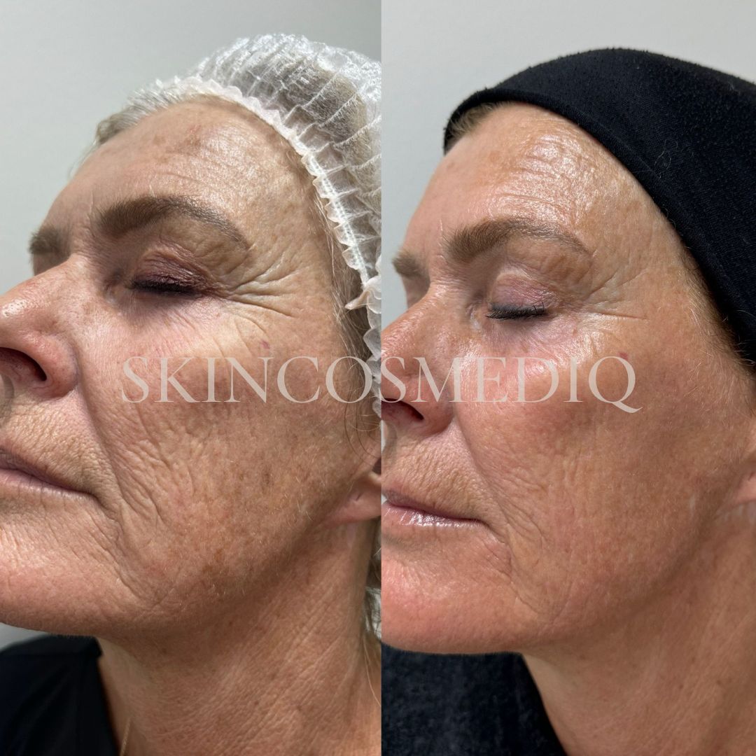 Resultaat Resultaat 1x IPL Alpha + 1x Sylfirm2