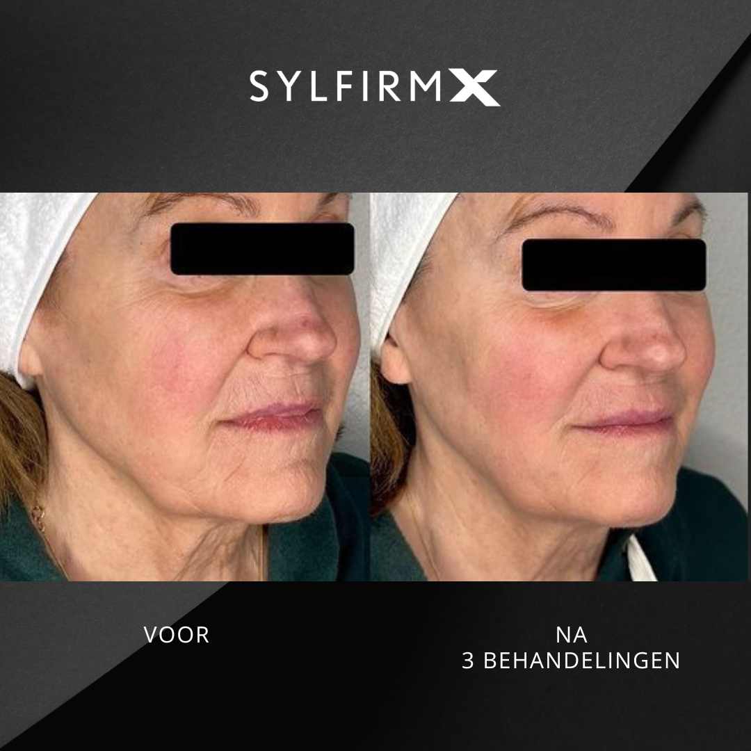 Sylfirm X voor&na7